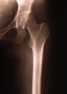 Schadevergoeding kunstheup Schadevergoeding kunstheup