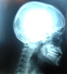 Whiplash informatie Whiplash symptomen